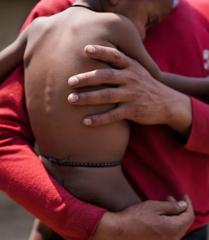 60% kids under-5 in India are micronutrient deficient, 40% anaemic: AIIMS