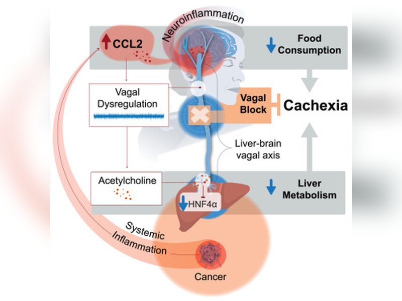 कैंसर मरीजों का तेजी से क्यों घटता है वजन, शोध में सामने आई वजह