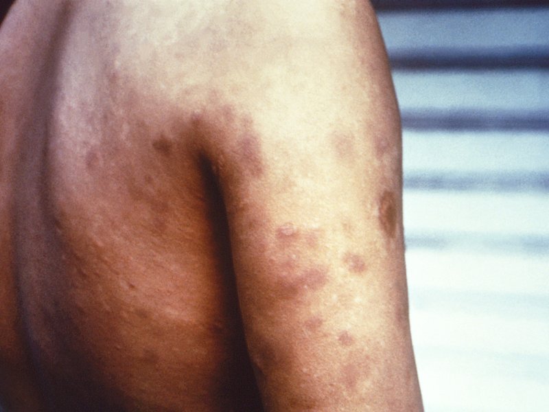 Leprosy now a “notifiable disease” in Maharashtra