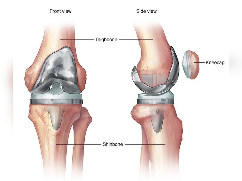 India needs more skilled surgeons for revision knee, hip replacement surgeries, say experts