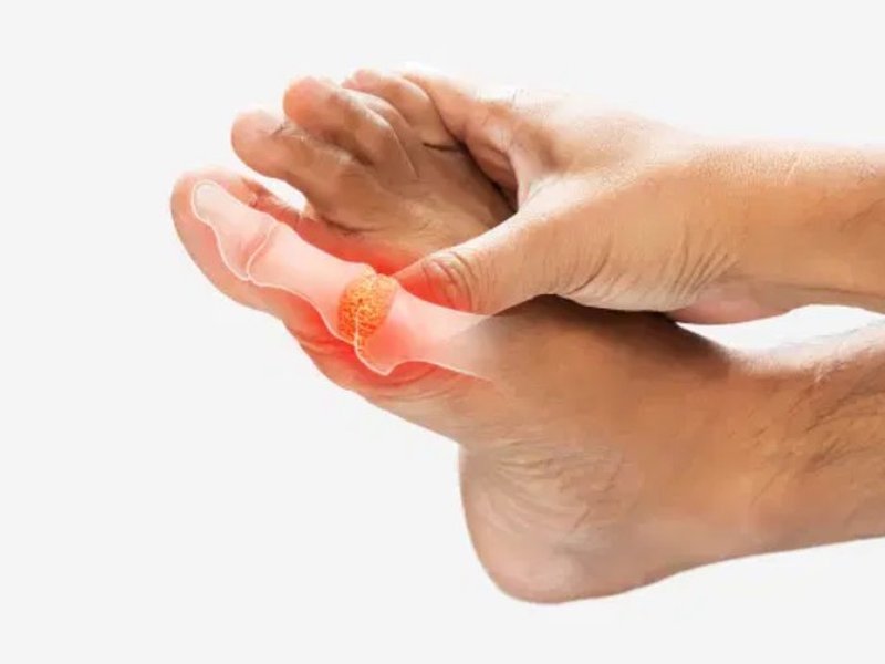 Ayurveda for Arthritis