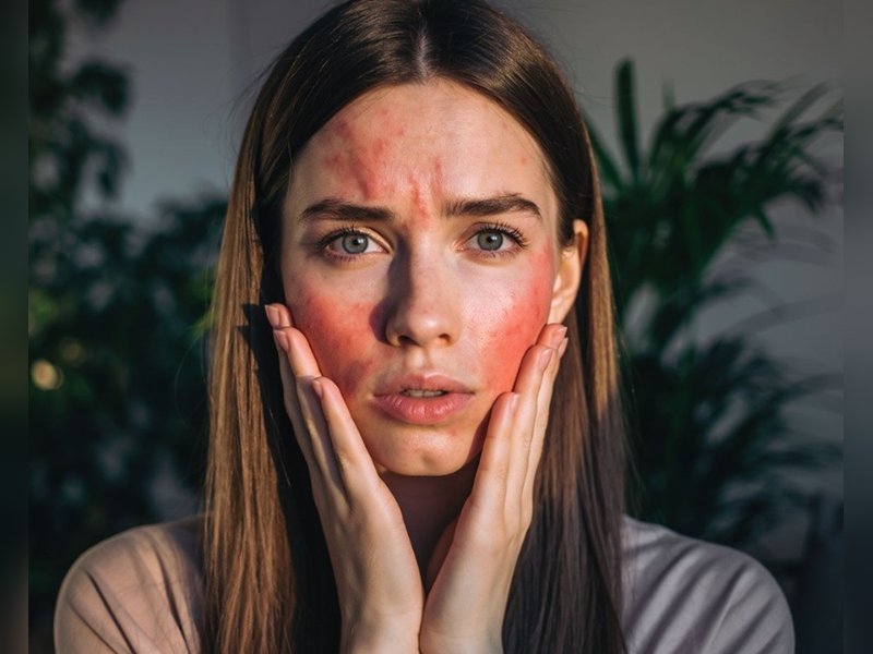 सर्द मौसम और आहार की कमी का संकेत देते हैं फटे गाल, इन उपायों से मिलेगी राहत