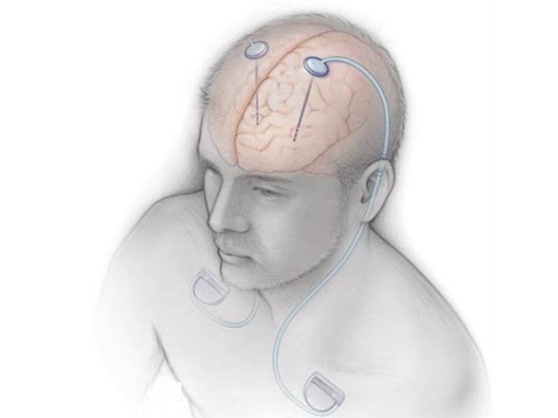 AIIMS conducts India’s 1st Deep Brain Stimulation workshop for Parkinson’s, movement disorders