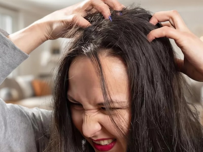 सिर से जूं को तुरंत खत्म करेंगे ये दो उपाय, खुजली और डैंड्रफ से भी मिलेगी राहत