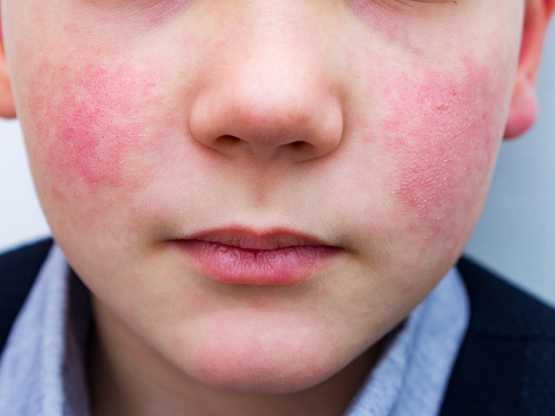 Common parvovirus B19 can cause serious encephalitis: AIIMS Bhopal