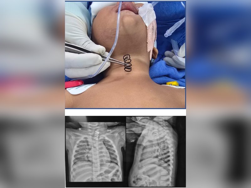 AIIMS doctors remove 2-inch-long metal spring from 14-month-old's food pipe