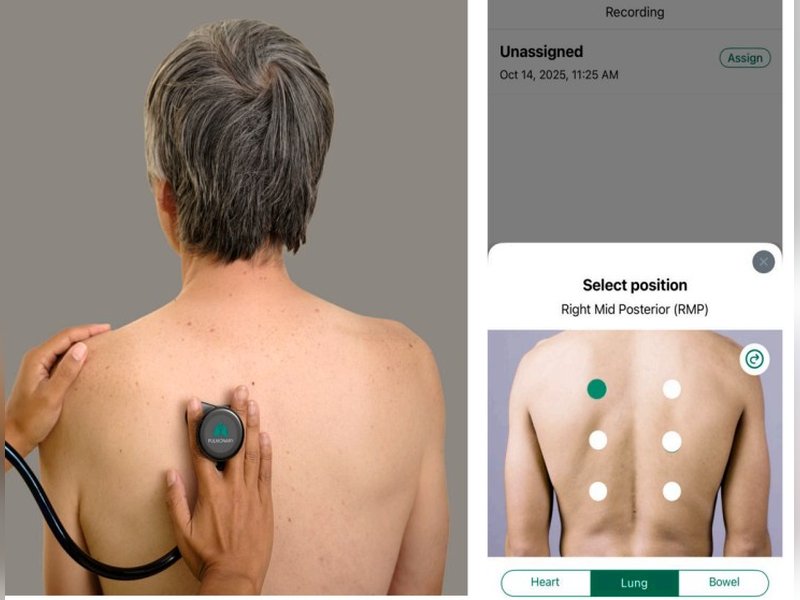 AI-powered digital stethoscopes show promise in bridging screening gaps