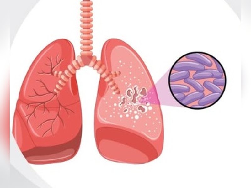 क्या है लेटेंट टीबी? नजरअंदाज करना पड़ सकता है भारी, जानें लक्षण और बचाव