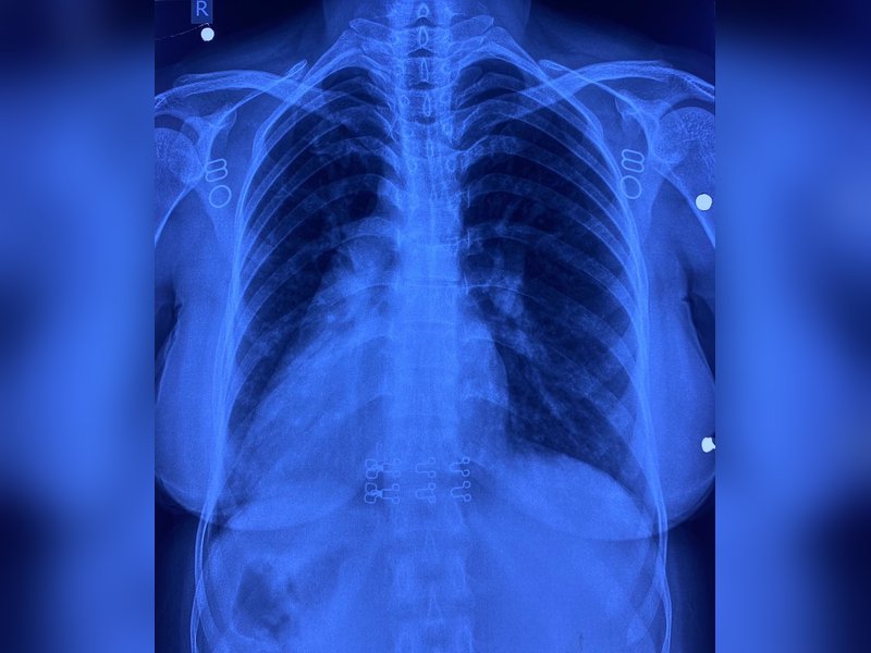 नई दिल्ली : आरएमएल अस्पताल की बड़ी सफलता, कार्डियक सर्जरी टीम ने सम्पन्न की जटिल सर्जरी