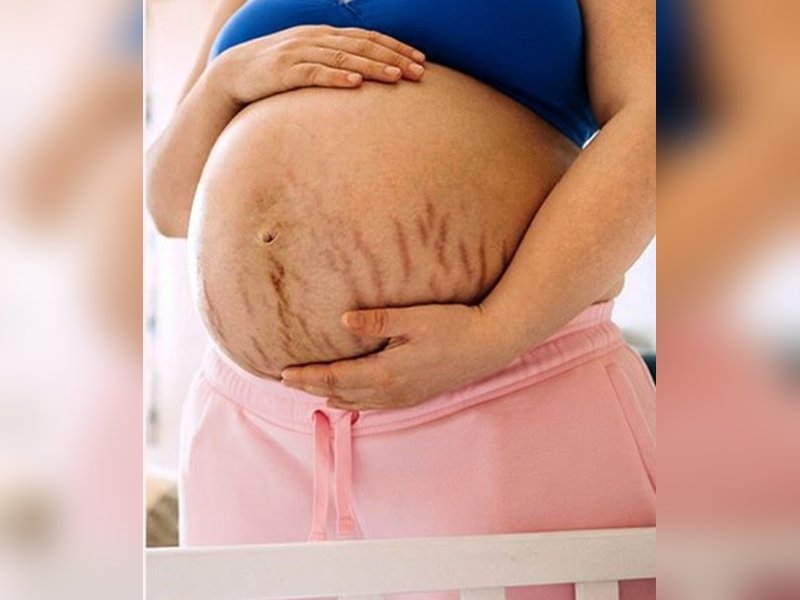 गर्भावस्था में स्ट्रेच मार्क्स? आयुर्वेद से जानिए बचाव के लिए उपाय 