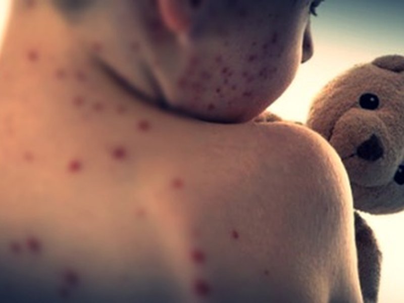 Bangladesh measles outbreak: Four more children die; toll rises to 280