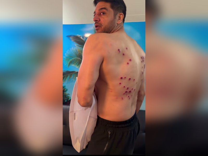 Gaurav Khanna shows painful laser burn marks on his back from 'Khatron Ke Khiladi' task