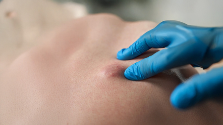 क्या शरीर में बनने वाली हर गांठ खतरनाक होती है? आयुर्वेद से जानें अर्बुद और ग्रन्थि में फर्क