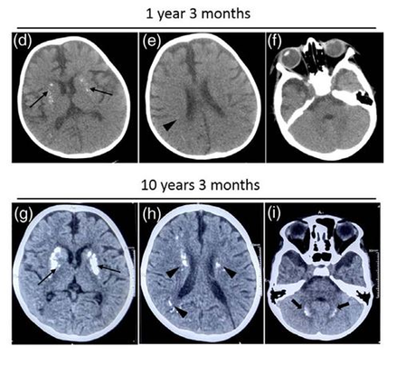 Indian researchers find rare gene mutation linked to recurrent neurological decline in kids