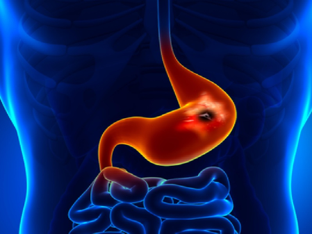 चुपचाप पैर पसारती है ये आंत से जुड़ी बीमारी, लक्षणों को न करें अनदेखा चुपचाप पैर पसारती है ये आंत से जुड़ी बीमारी, लक्षणों को न करें अनदेखा