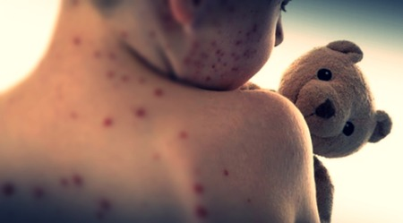 Bangladesh measles outbreak: Four more children die; toll rises to 280